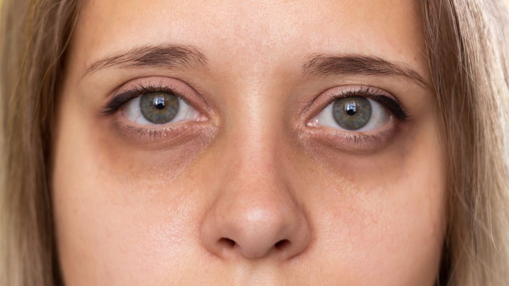 ¿Qué son las ojeras y cuáles son sus causas principales