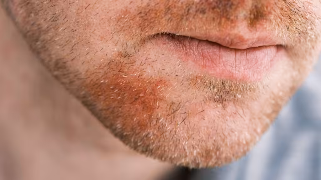 Causas de la dermatitis seborreica
