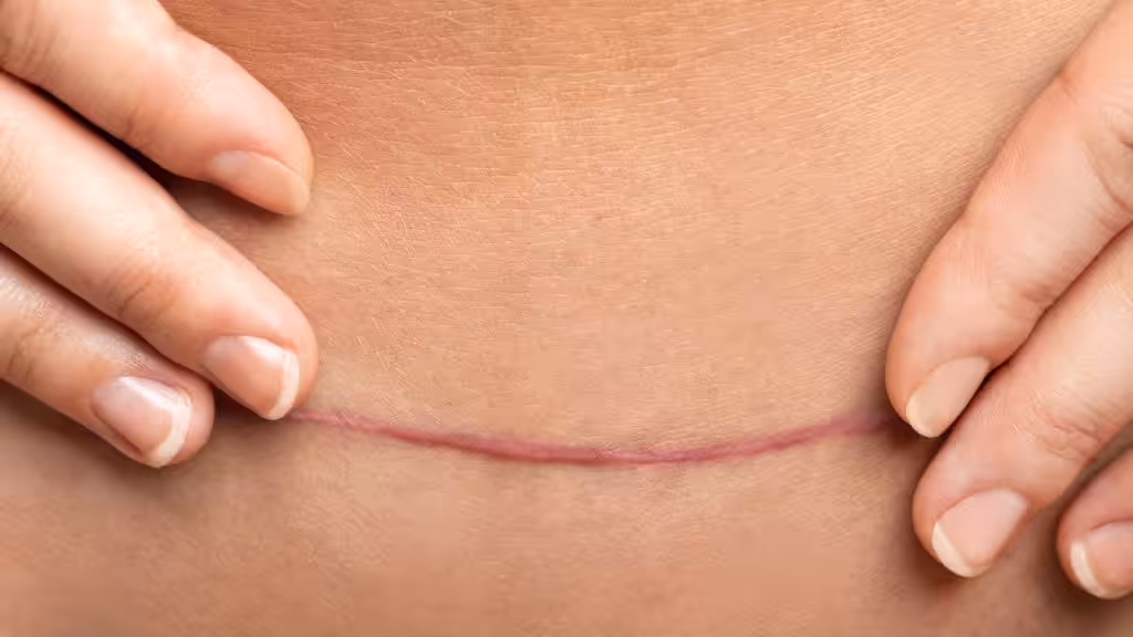 Cuidados diarios para minimizar el impacto solar en cicatrices