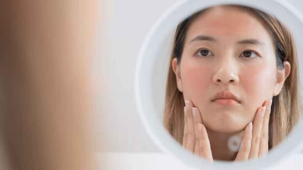 Síntomas comunes de la rosácea