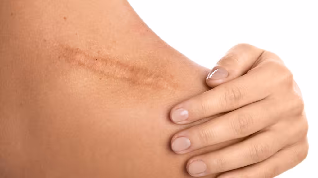 Tipos de cicatrices y su sensibilidad al sol