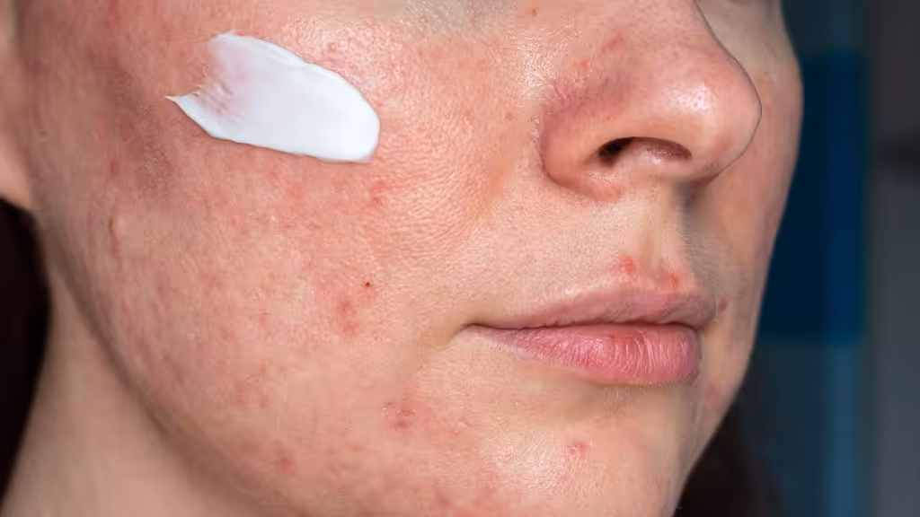 Tipos de rosácea y cómo identificarlos