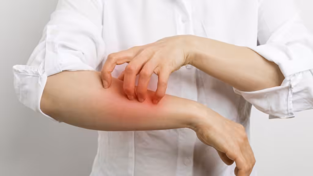 Tratamientos para la alergia al sol