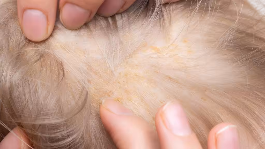 Tratamientos para la dermatitis seborreica