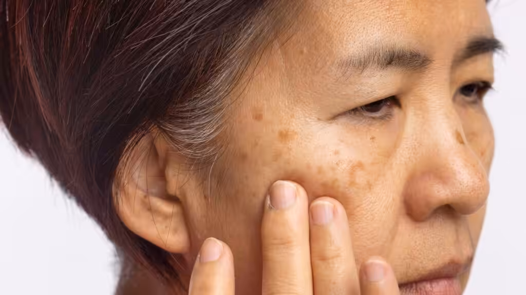 Tratamiento melasma 