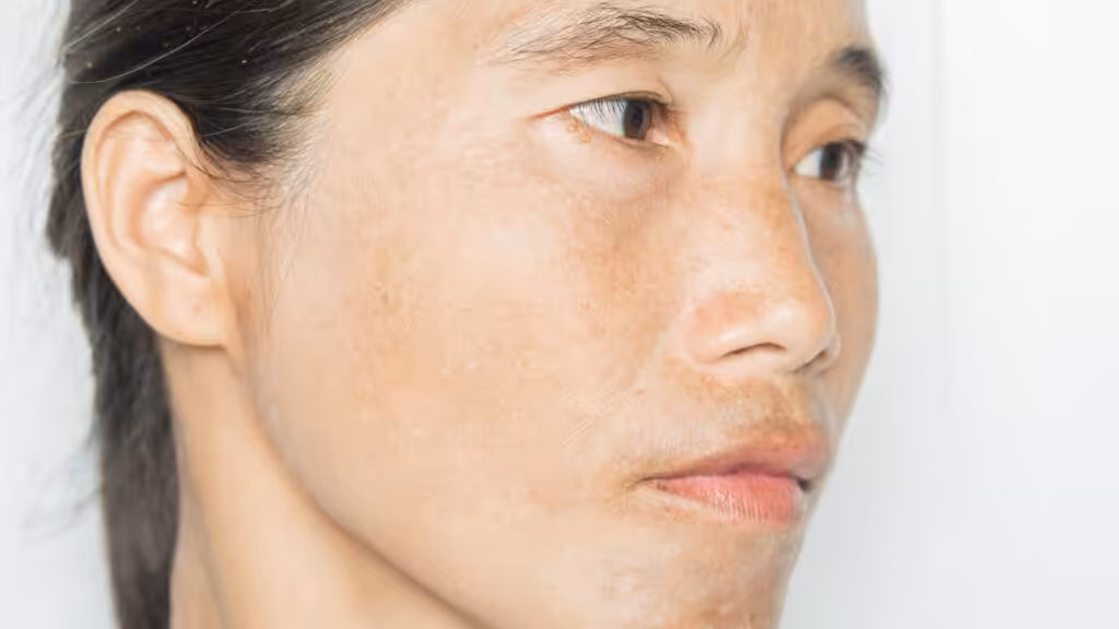 Tratamientos profesionales para las manchas el bigote