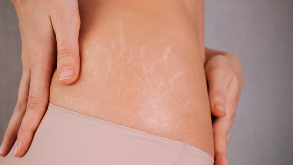 Importancia de la hidratación para prevenir estrías