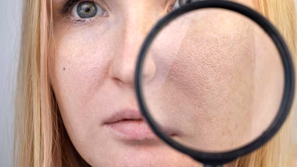 Tratamientos dermatológicos para los poros abiertos
