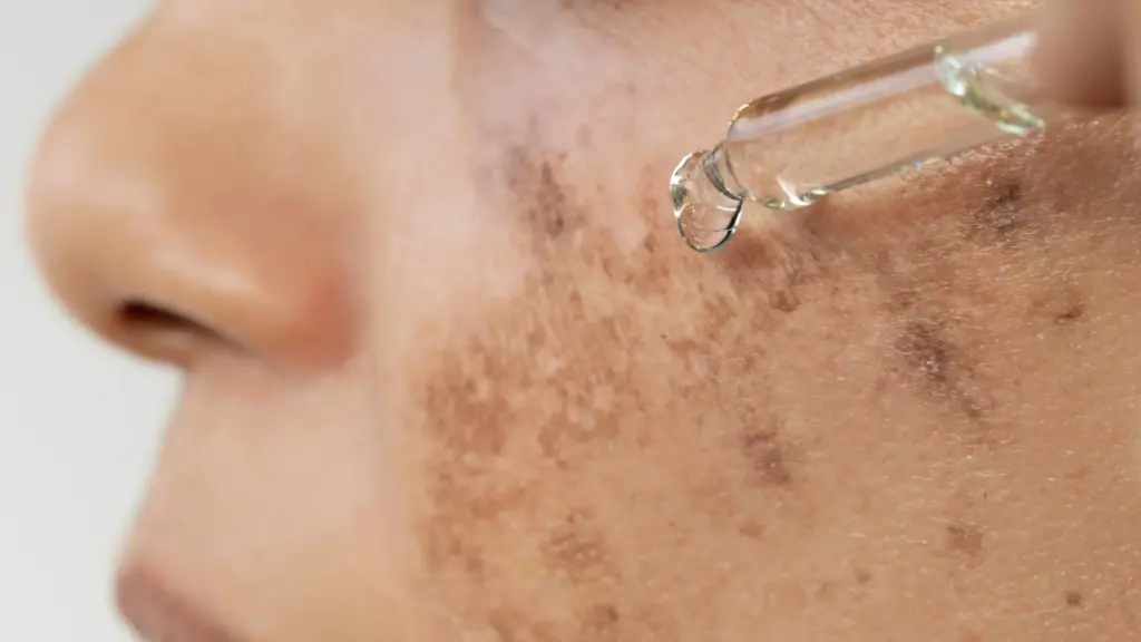 Melasma: La mancha de origen hormonal